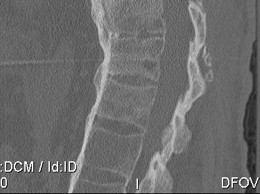 Ankylosing Spondylitis CT Spine Sagittal